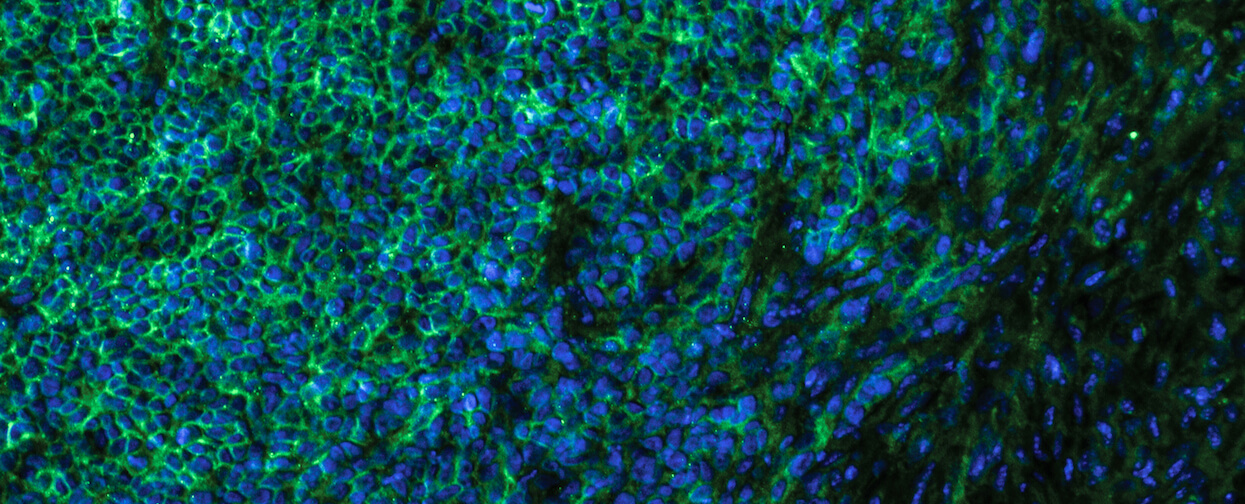 Immunofluorescent staining of efficient metastasizing melanoma cells (MCT1 proteins stained green and cell nucleus in blue).